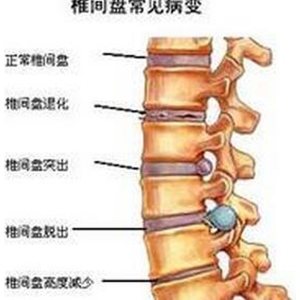 腰间盘突出