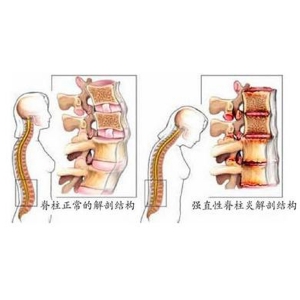 强直性脊柱炎