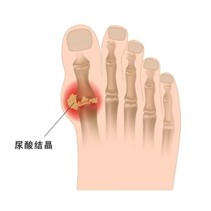 痛风
